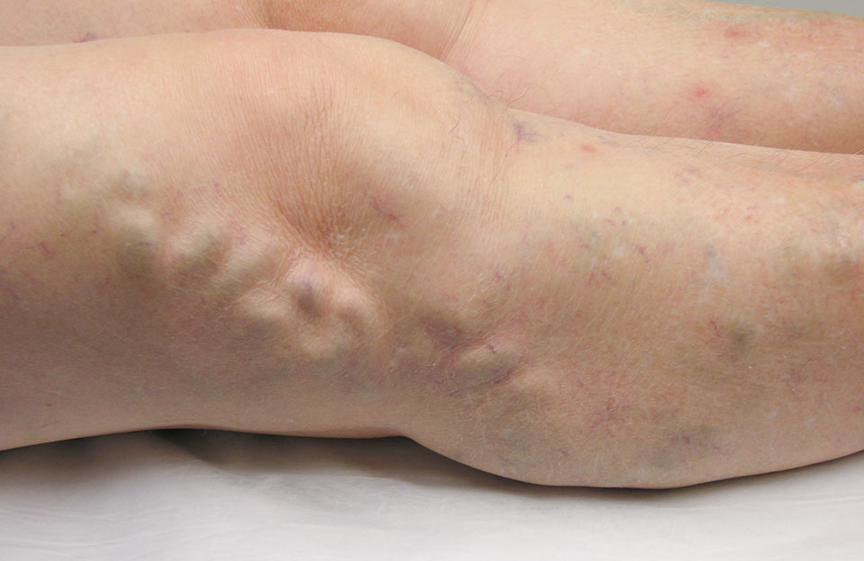 Varicose Veins