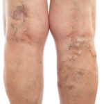 varicose vein treatment