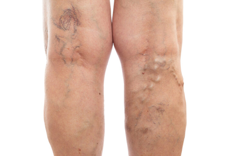 varicose vein treatment