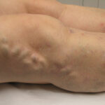 brisbane varicose vein
