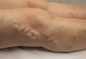 brisbane varicose vein