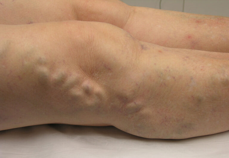 brisbane varicose vein